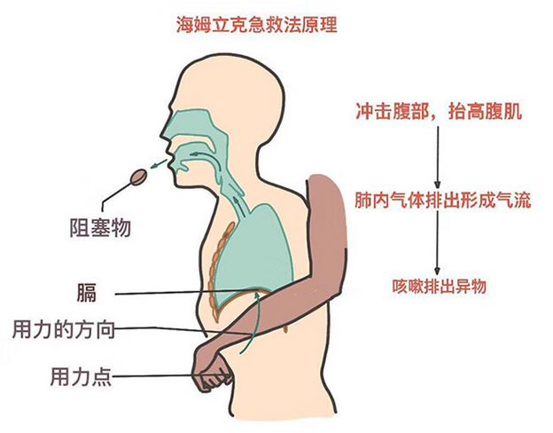 成人海姆立克示意圖